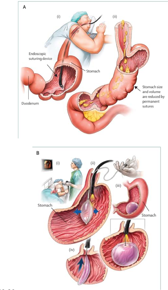 <p>reduce gastric volume to delay gastric emptying by endoscopic sleeve gastroplasty or intragastric ballon </p>