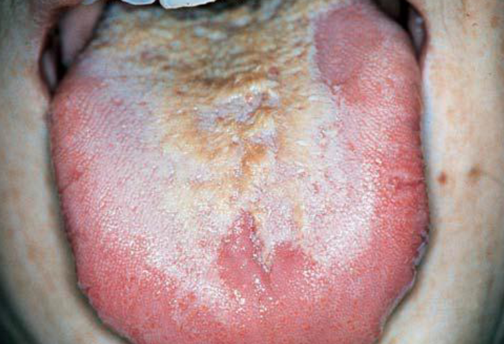 <p>white plaque on tongue that can be wiped off, due to imbalance in oral environment </p>