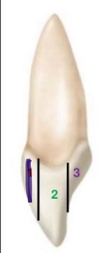 <p>what division is this in the facio-lingually (crown)</p>