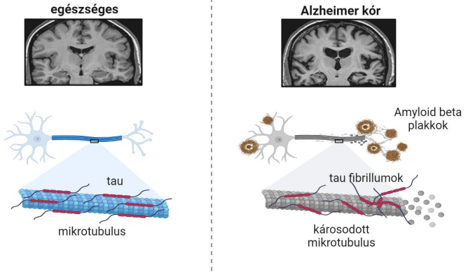 <p>Kolinerg neuronok pusztulnak, csökkent Ach transzmisszió a hipocampusban</p><p>Amyloid kaszkád elmélet: EC patológiás béta-amyloid felhalmozódás</p><p>Tau hipotézis: IC hiperfoszforilált tau fibrillumok felhalmozódása, mikrotubulus dezintegráció, a citoszkeleton összeomlik</p>