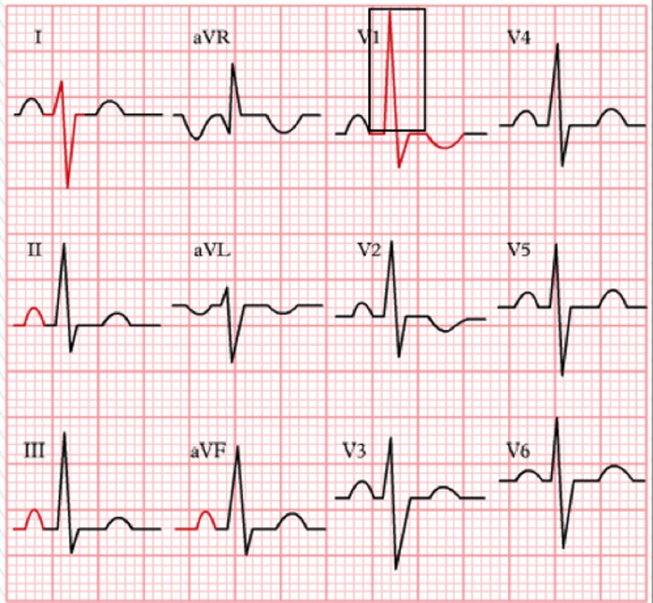 <p>Lead V1; large R wave > 7 small boxes (right ventricle wall is thicker so more depolarization energy towards this lead)</p>