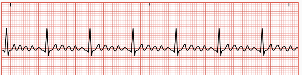<p>occurs when the atria are beating in a regular rhythm + increased rate</p><ul><li><p>caused by multiple rapid electrical impulses being sent from the atrial too quickly for the AV node to process before the transmission to the ventricles&nbsp;</p></li></ul><p></p>