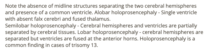 <p>b) alobar holoprosencephaly, trisomy 13</p>