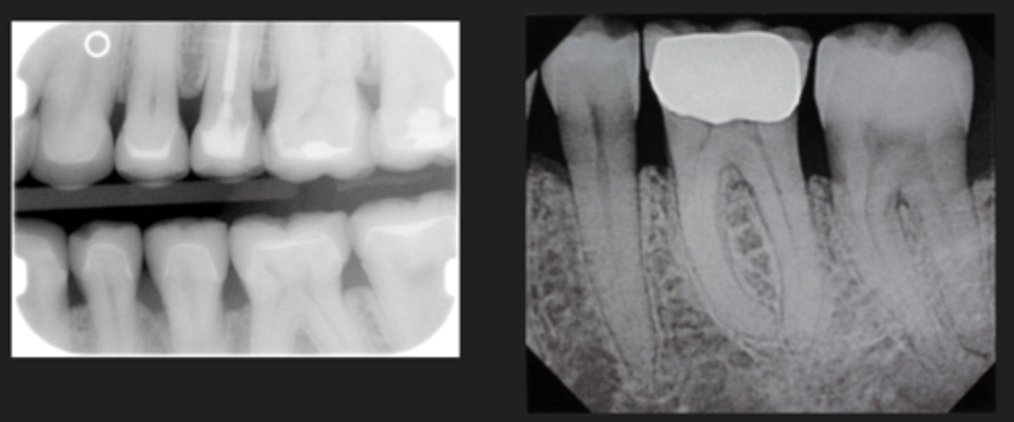 <p>- Porcelain-Fused-to-metal (PFM)</p>