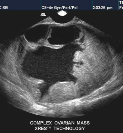 <p>whats the score of this ovarian mass?</p>