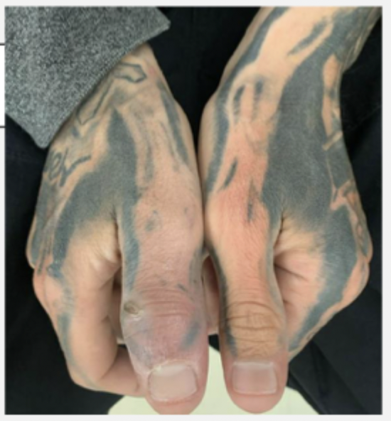 <p>45 y/o male presents to the ED with hand pain. On physical exam you note tenderness over the thumb that is red and swollen with a small open wound. Vitals are stable with an exception of a fever. What diagnostics you want?</p>