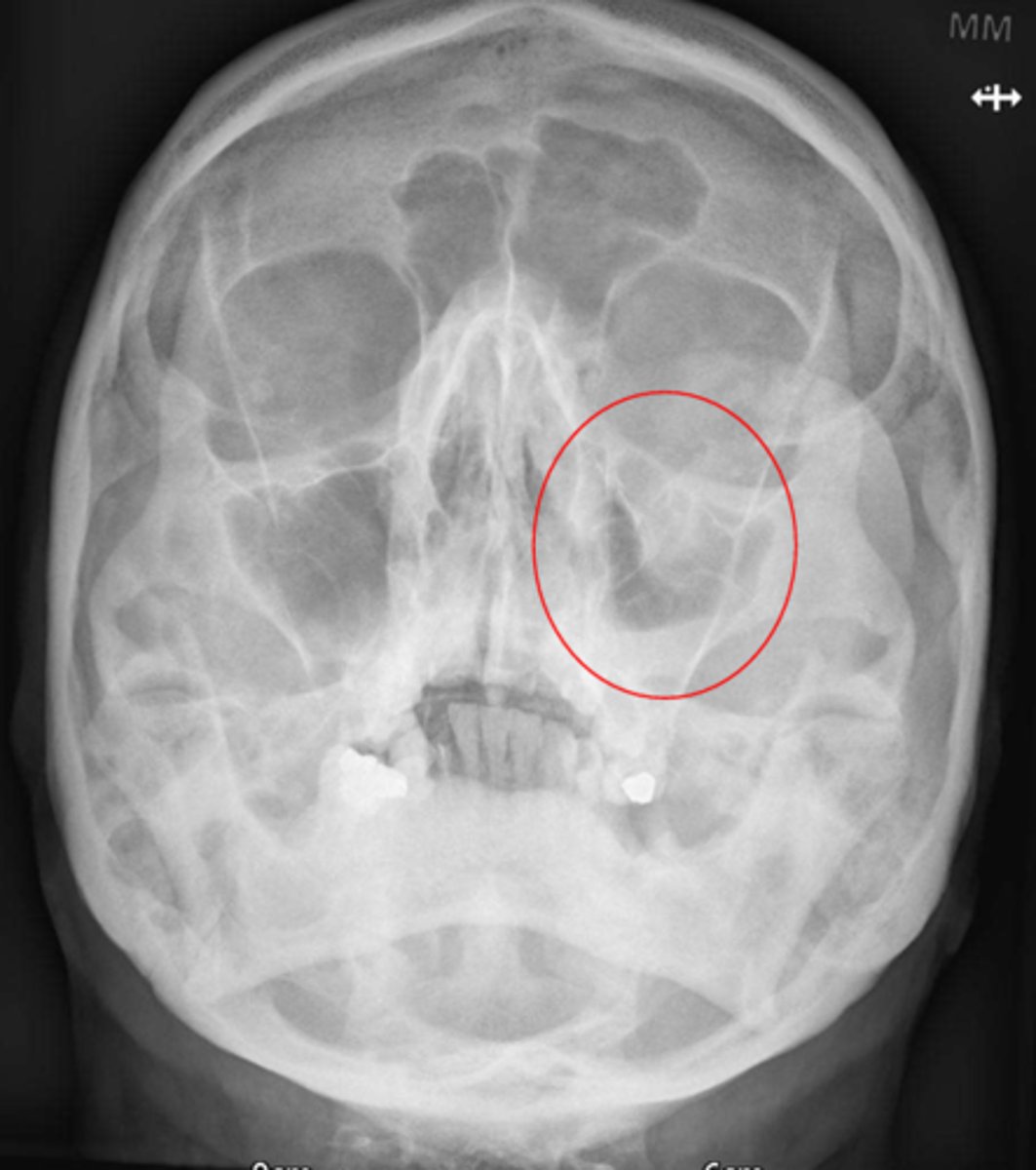 <p>What type of fracture is this?</p>