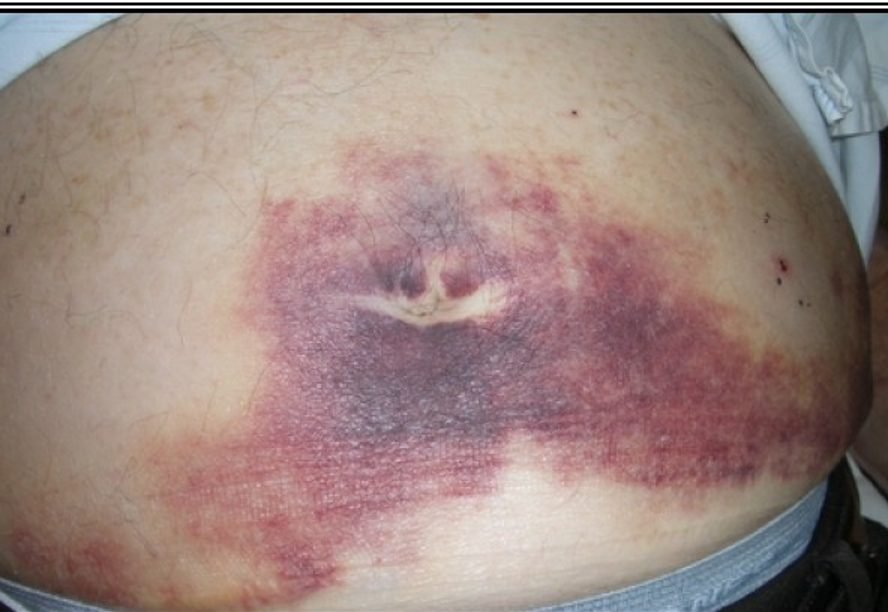 <p><strong>What is a bluish periumbilical discoloration (usually accompanied by grey turner sign) from peritoneal hemorrhage?</strong></p>