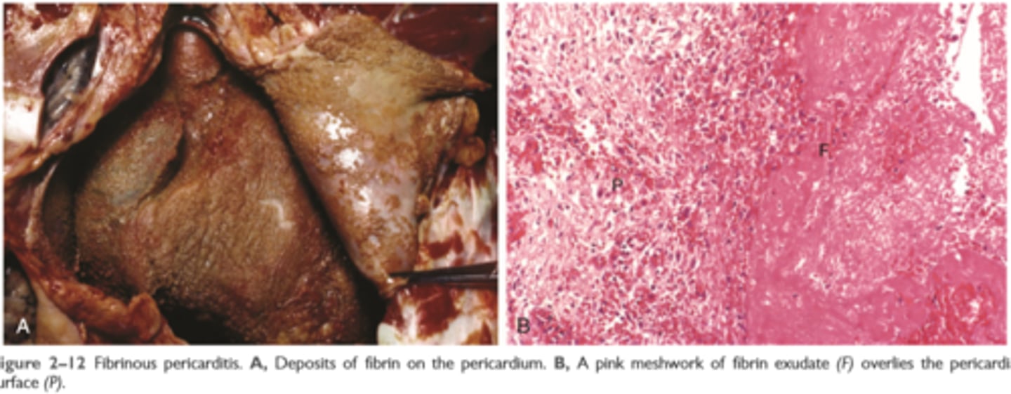 <p>occurs as a consequence of more severe injuries, resulting in greater vascular permeability that allows large molecules (such as fibrinogen) to pass the endothelial barrier</p><p>Histologically, the accumulated extravascular fibrin appears as an eosinophilic meshwork of threads or sometimes as an amorphous coagulum (Fig. 2-12)</p><p>A fibrinous exudate is characteristic of inflammation in the lining of body cavities, such as the meninges, pericardium, and pleura</p><p>Such exudates may be degraded by fibrinolysis, and the accumulated debris may be removed by macrophages, resulting in restoration of the normal tissue structure (resolution)</p><p>extensive fibrin-rich exudates may not be completely removed, and are replaced by an ingrowth of fibroblasts and blood vessels (organization), leading ultimately to scarring that may have significant clinical consequences</p>