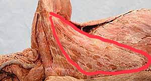 Which muscle is outlined in red