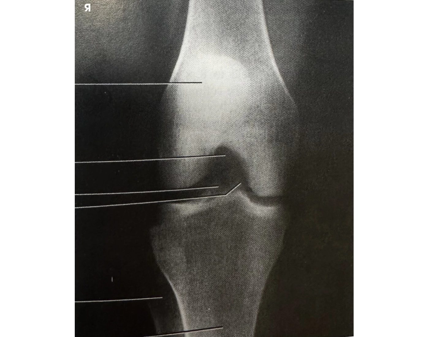 <p>camp coventry</p><p>intercondylar fossa</p><p>40-50°</p><p>lower leg</p>