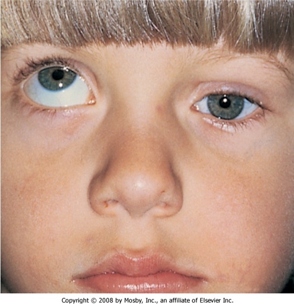 <p>ptosis and inability to elevate and adduct eye</p>