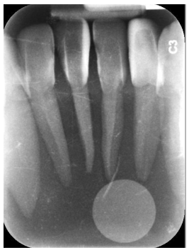<ul><li><p>Radiopaque circle on the radiograph is the magnetic circle on the phosphorus plate </p><ul><li><p>Reason: film placed backwards in mouth </p></li></ul></li><li><p>Fix: ensure proper side of the film is placed facing the PID. </p></li></ul><p></p>