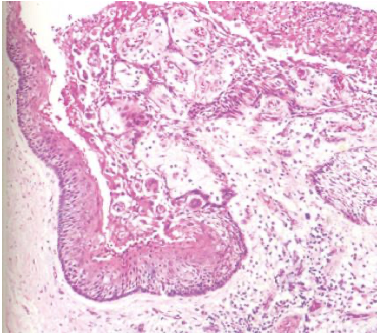 <p>A 55 year old patient present with mild swelling of upper jaw. A biopsy was taken and the image is provided below.</p>