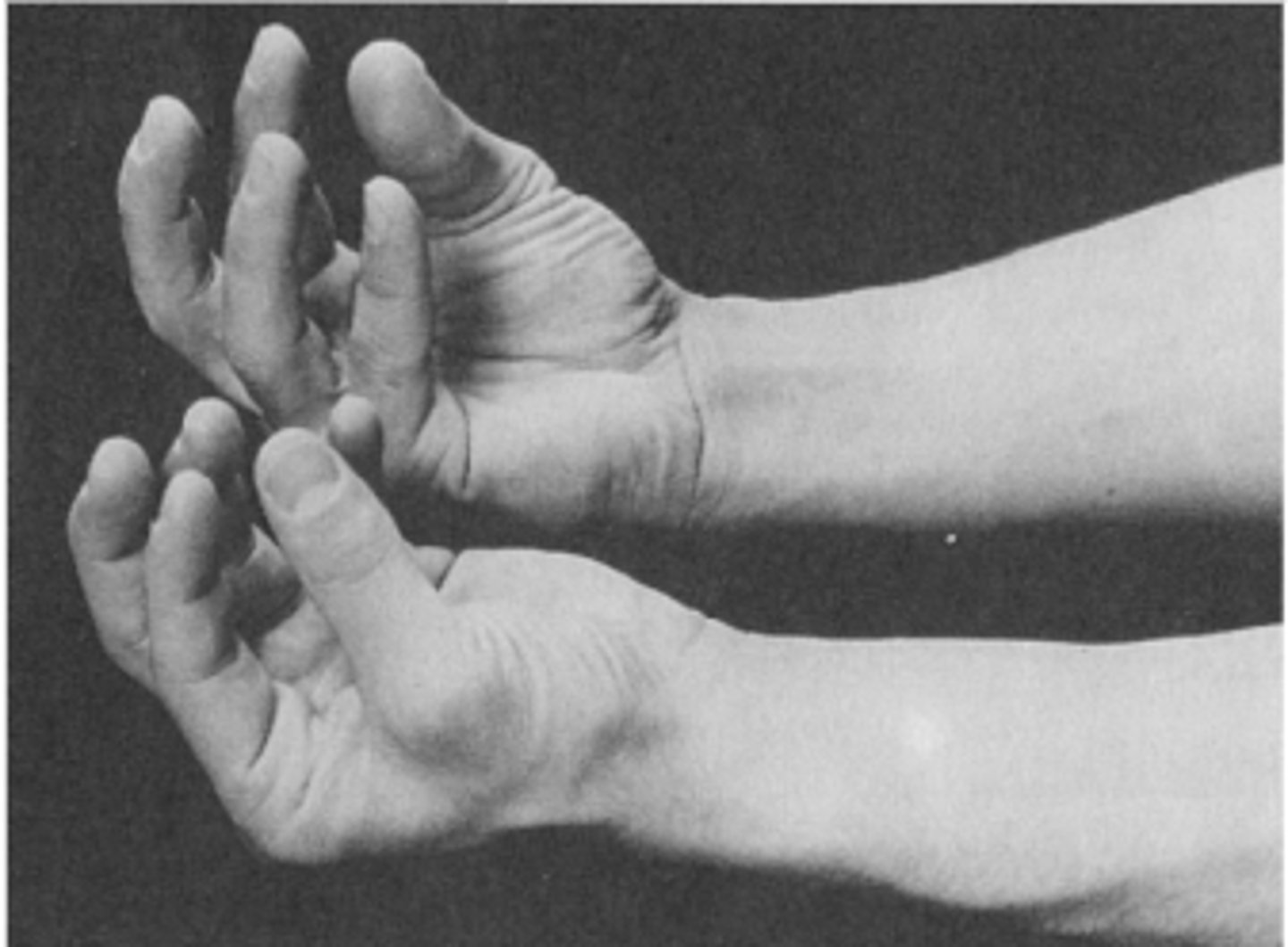 <p>alkar a csuklóig alátámasztva, rögzítem, kéz lelóg supinatióban</p><p>> dorsalflexióból végezzen színtiszta volarflexiót</p>