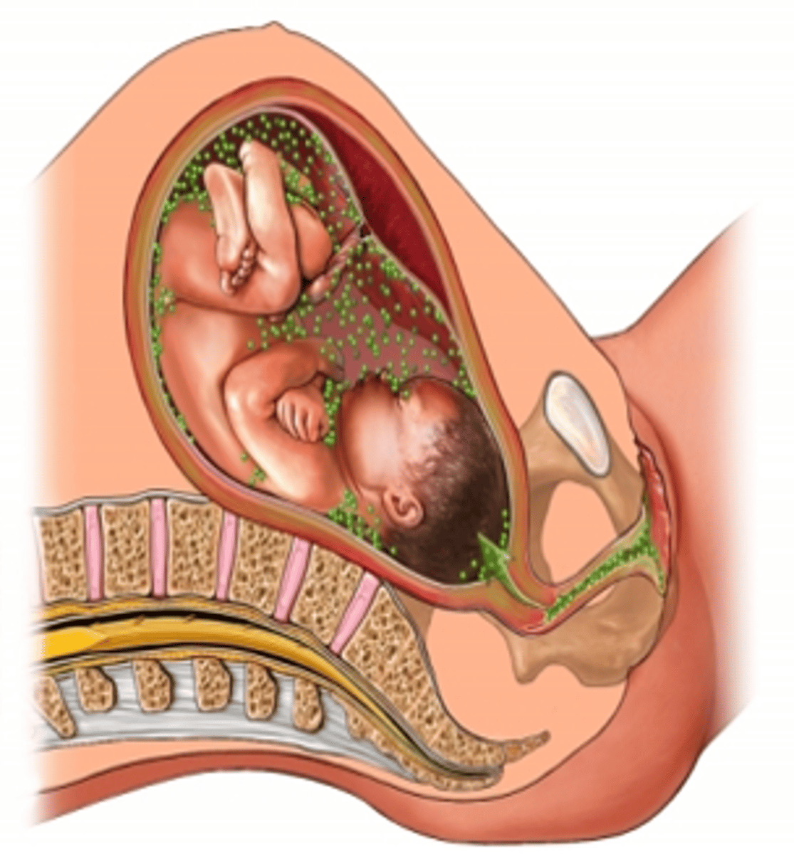 <p>-Referred to as GBS (Group B streptococcus)<br>-Colonization predisposes newborns to respiratory distress and septicemiathat may progress to meningitis</p>