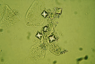 Dihydrate calcium oxalate crystals