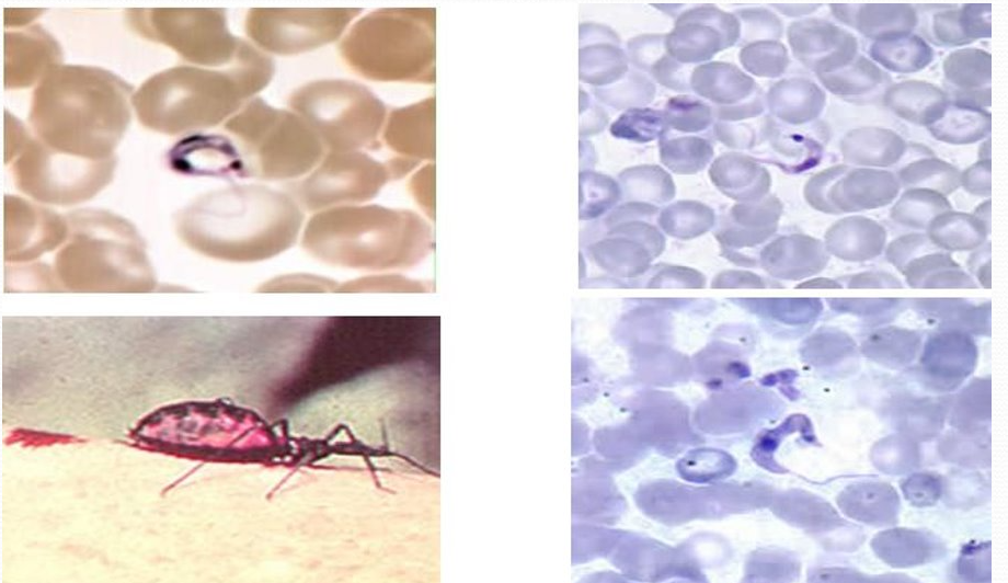 <p>caused by Trypanosoma cruzi</p><p>vector = <span style="color: red">Triatomine bugs (kissing bugs)</span> in rural areas of Latin America</p><p>IS = inf’d kissing bug takes blood meal → poops <span style="color: red">metacyclic trypomastigotes</span> in feces near wound</p><p>dx: trypomastigotes in blood (larger kinetoplasts comp to T. brucei), ELISA, IFA, EIA, pt hx</p>