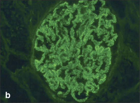 <p>What condition is this</p>