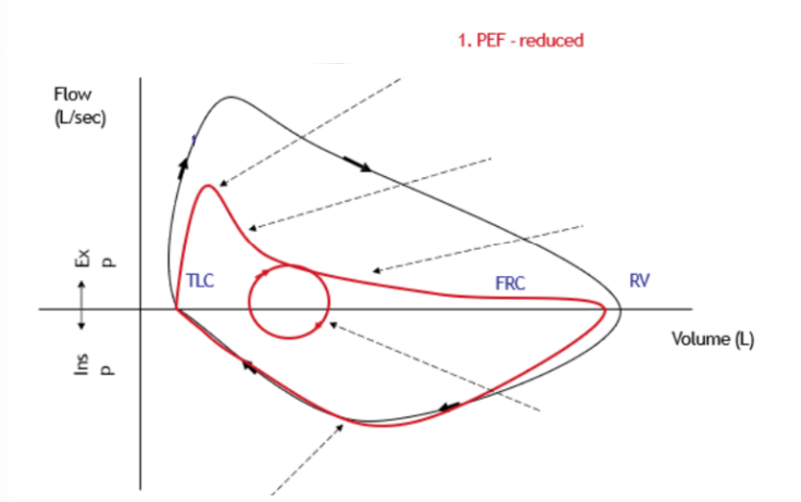 <p><span>Reduced:&nbsp;</span></p><ul><li><p><span>Elastic recoil reduced → greater tendency for airways to collapse as reduced peak alveolar pressure</span></p></li><li><p><span>Results in a reduced driving pressure during expiration → reduced PEF</span></p></li></ul>