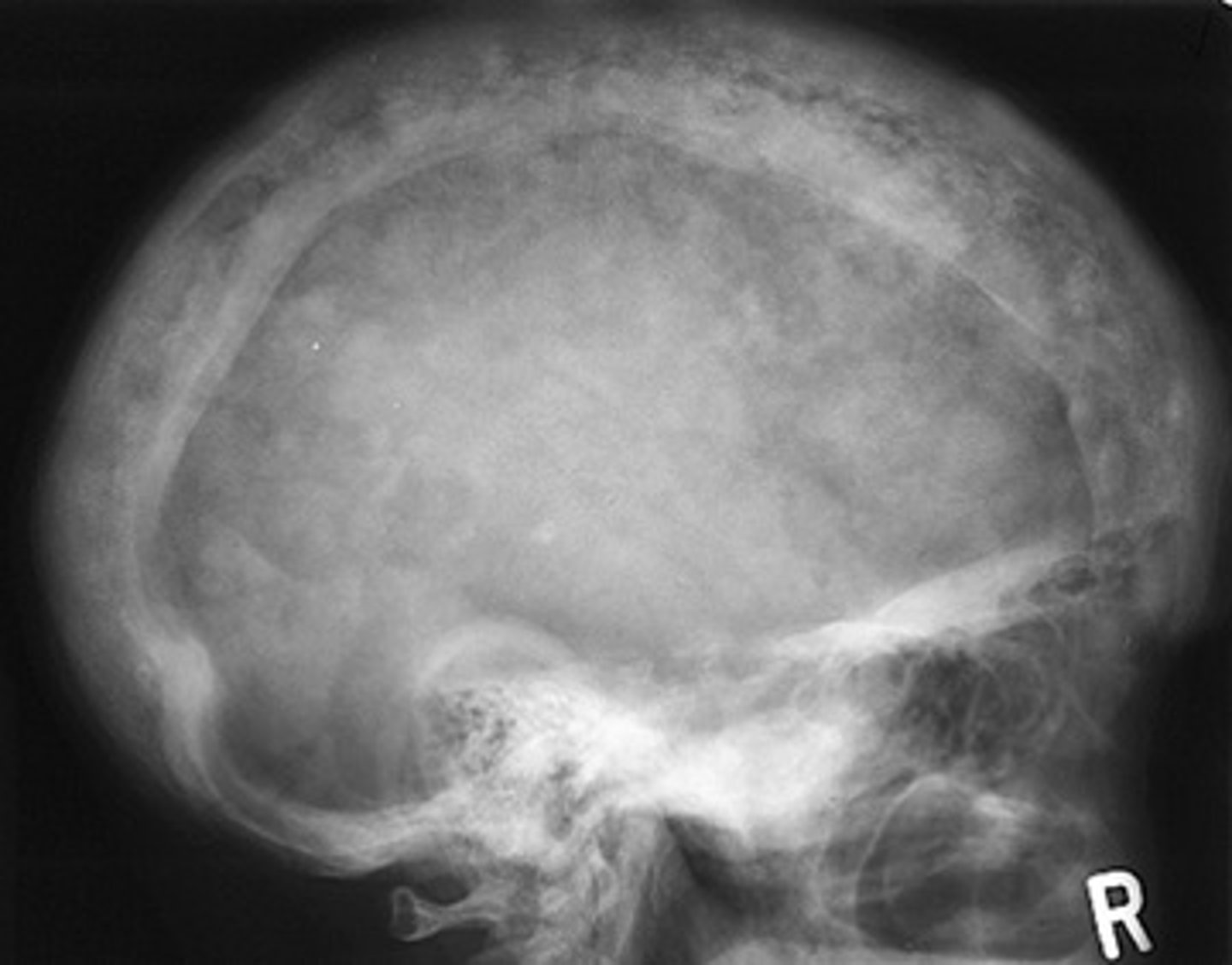 <p>What is this disease and the mechanism for it?</p>