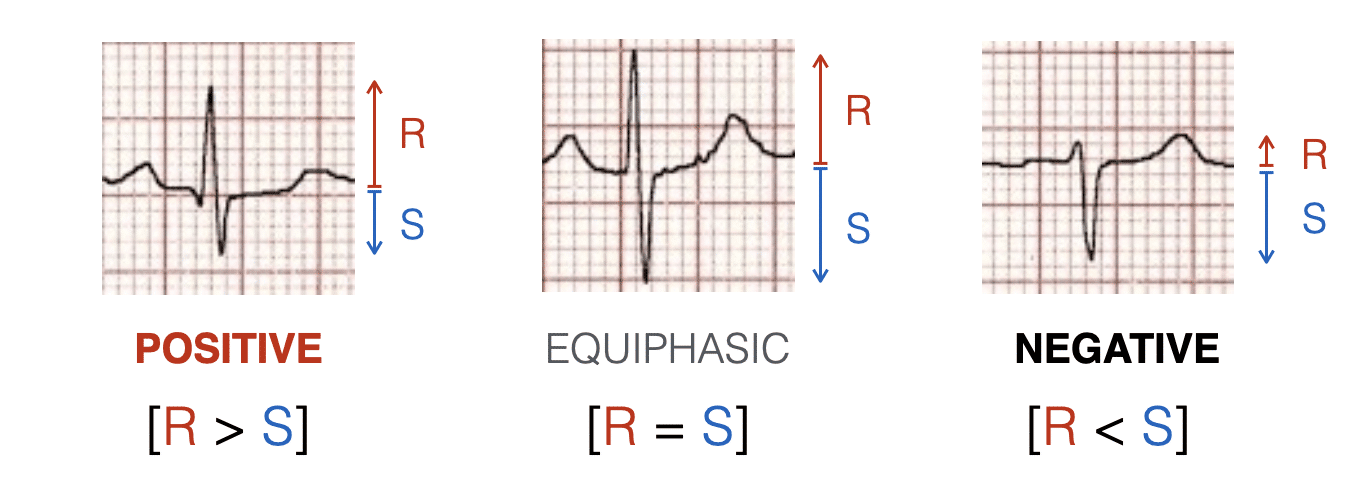If QRS is biphasic = MEA is approx at right angles