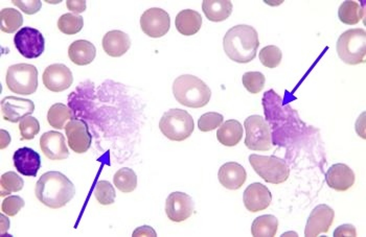 <p>chronic lymphocytic leukemia (CLL)</p><p>- only in PB</p><p>- any cell thats partially ruptured</p>
