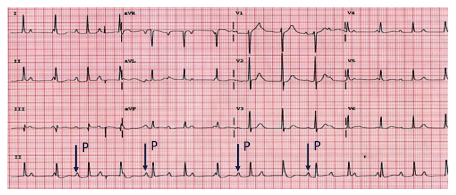 <p>AV Blocks: 3rd Degree</p><ul><li><p>Characteristics: (3)</p></li></ul><p></p>