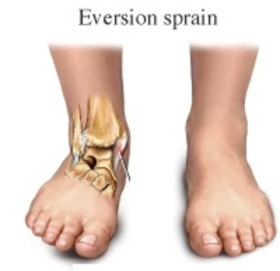 <p>Ankle Eversion</p>