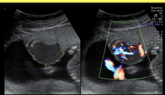 <p>which describes a <strong>chorioangioma</strong></p><p>.</p><p>a) mass of hypervascular placental tissue that <strong>forms separate from the placenta</strong></p><p>b) benign ovarian mass that causes hypersecretion of testosterone</p><p>c) benign hypervascular <strong>placental mass</strong> that leads to polyhydramnios</p><p>d) triangular shaped anechoic area within the placenta</p>