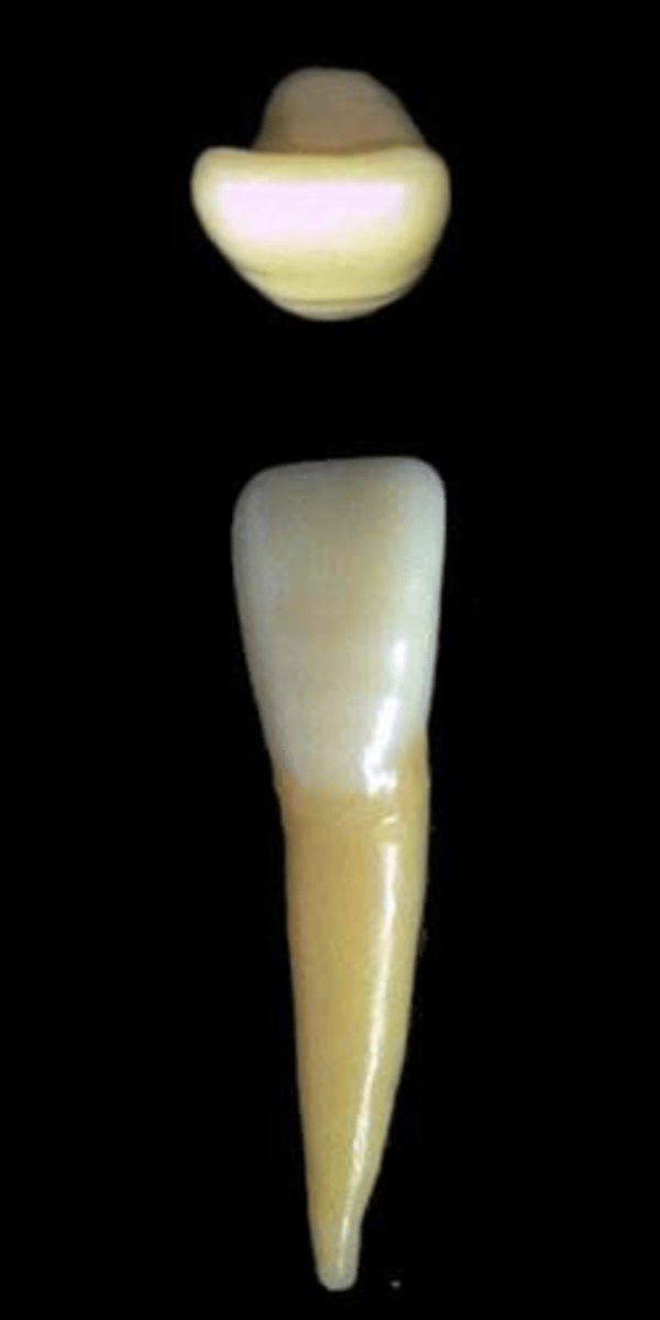 <p>what tooth is this &amp; why?</p>
