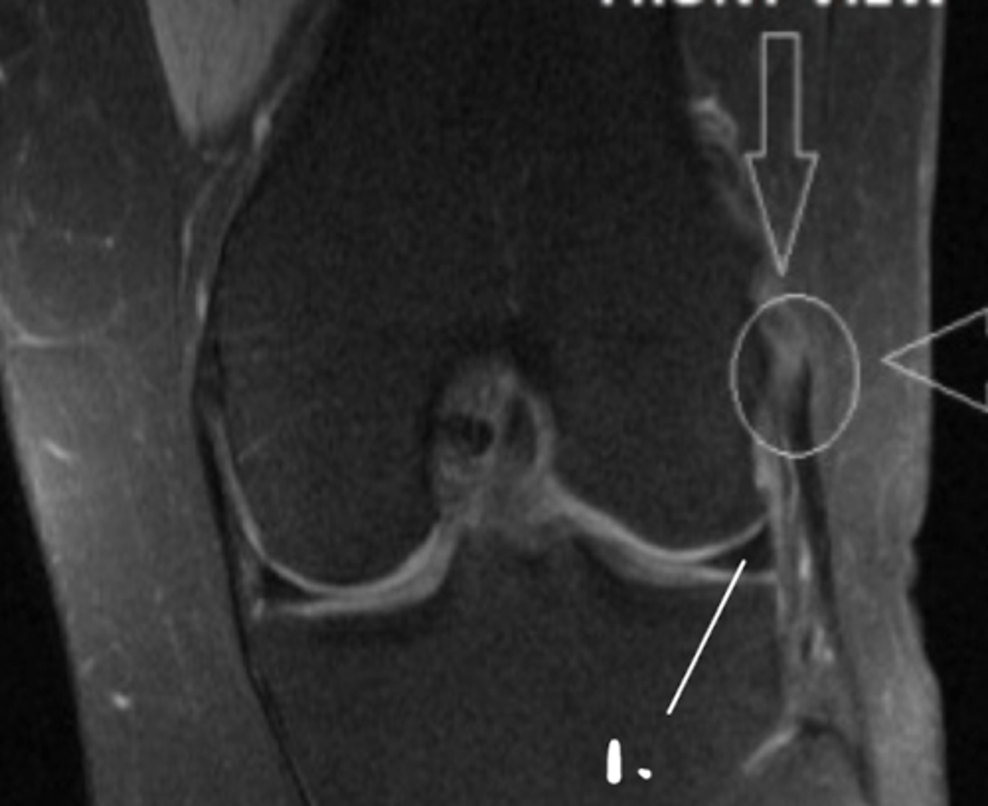 <p>Define the pathology. (#1 is just pointing to the meniscus)</p>