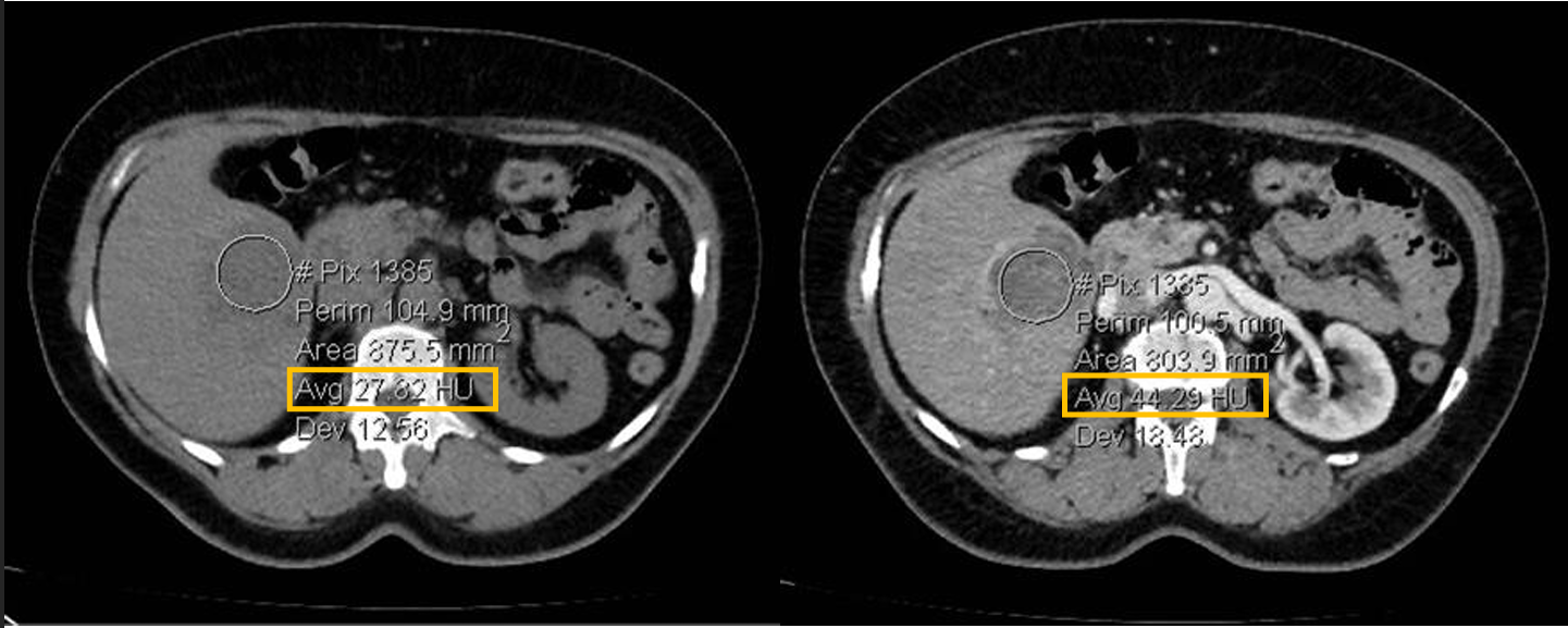 <p>Patient history: tumor search in a middle-aged patient with fatigue and weight loss</p><p>Modality: left image – non-enhanced CT; right image – arterial phase enhanced CT (iodine-based contrast agent)</p><p>Region: upper abdomen, axial views</p><p>Radiologic sign: solid, contrast-enhancing (from 27 HU to 44 HU), hypodense mass in the 5-6th segment of the liver</p><p>Diagnosis: cholangiocarcinoma</p>