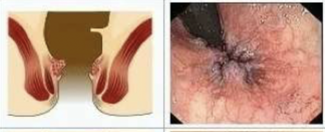 <p>Which grade of internal hemorrhoids has painless bleeding and on exam you find <strong>prominent vascular engorgement</strong> bulging into the canal without prolapse?</p>