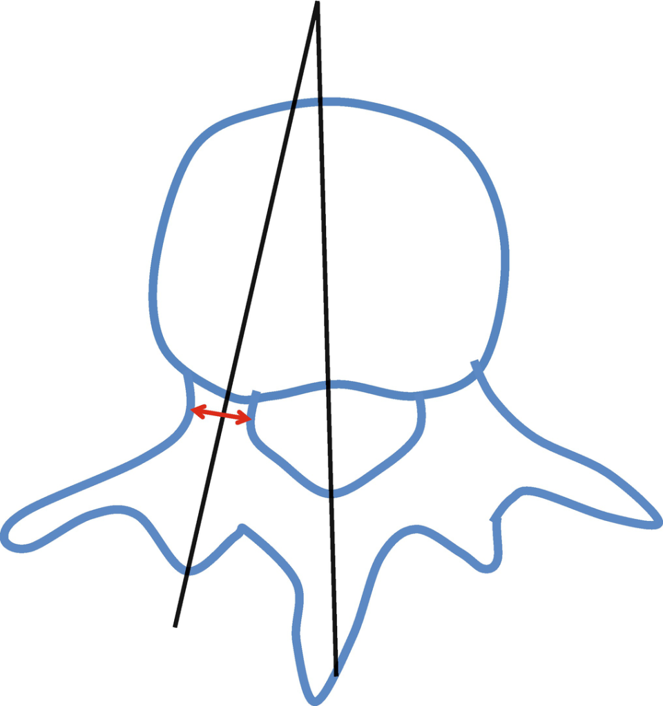 <p>The foot of the vertebral arch</p>