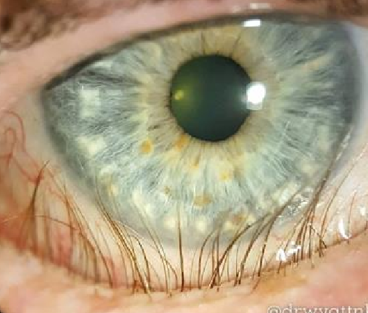 <p>What eyelash condition is this?</p>