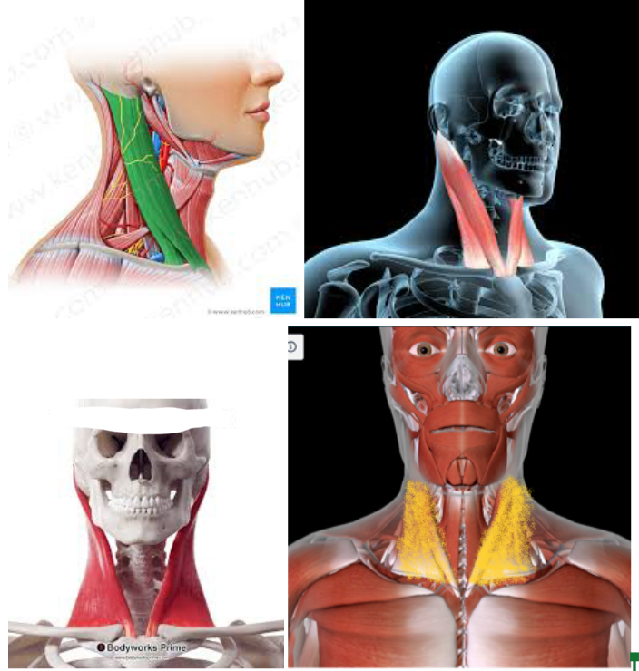 <ul><li><p><strong>Function</strong>: <strong>ROTATE HEAD</strong>/FLEX NECK</p></li><li><p><strong>Origin</strong>: <strong>MANUBRIUM of STERNUM MEDIAL CLAVICLE</strong></p></li><li><p><strong>Insertion</strong>: <strong>MASTOID PROCESS </strong>of the <strong>TEMPORAL BONE </strong></p></li></ul><p></p>