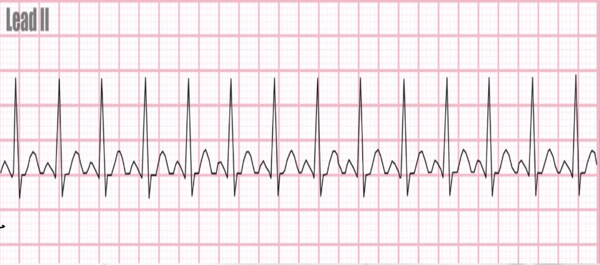 <p>Sinus tachycardia </p>
