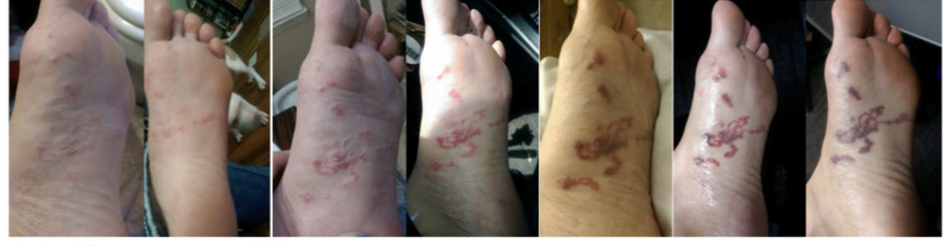 <ul><li><p><span style="background-color: transparent;"><span>•Humans exposed to L3 stage larvae&nbsp;</span></span></p></li><li><p><span style="background-color: transparent;"><span>•L3 penetrate the skins and cause a creeping eruption where localized migration occurs&nbsp;</span></span></p></li><li><p><span style="background-color: transparent;"><span>•Extremely pruritic</span></span></p></li><li><p><span style="background-color: transparent;"><span>•Self-limiting – larvae die in 5-6 weeks&nbsp;</span></span></p></li><li><p><span style="background-color: transparent;"><span>•Larvae cannot reach maturity in the human host</span></span></p></li><li><p><span style="background-color: transparent;"><span>Most commonly occurs with A.braziliense (don’t have to know for exam)&nbsp;</span></span></p><ul><li><p><span style="background-color: transparent;"><span>•Also known as “plumber’s itch”, which, as the name implies, affects plumbers who crawled in areas contaminated with larvae</span></span></p></li></ul></li></ul><p></p>