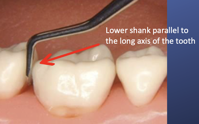 <p>is this the correct orientation of a posterior sickle scaler </p>
