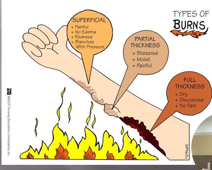 <p>First-Degree (Superficial) Burns</p>