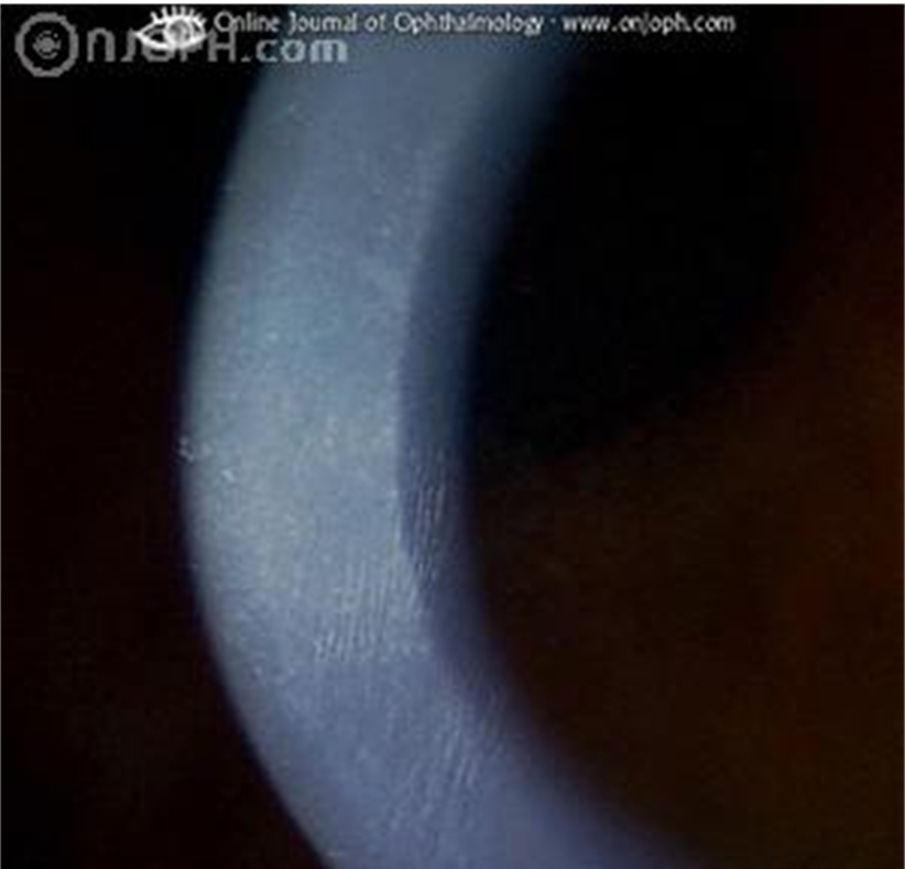 Vogt's striae