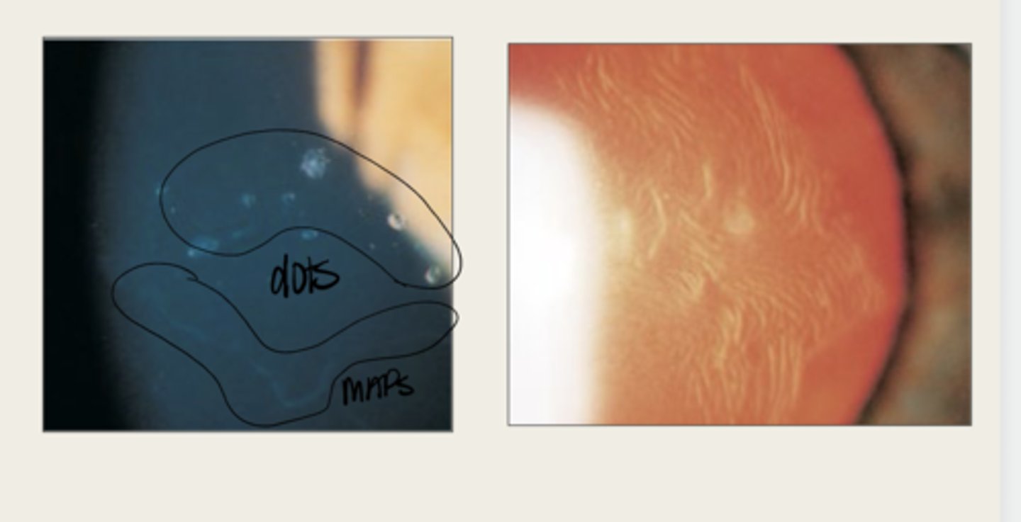 <p>What do the fingerprints appear as in Epithelial Basement Membrane Dystrophy?</p>