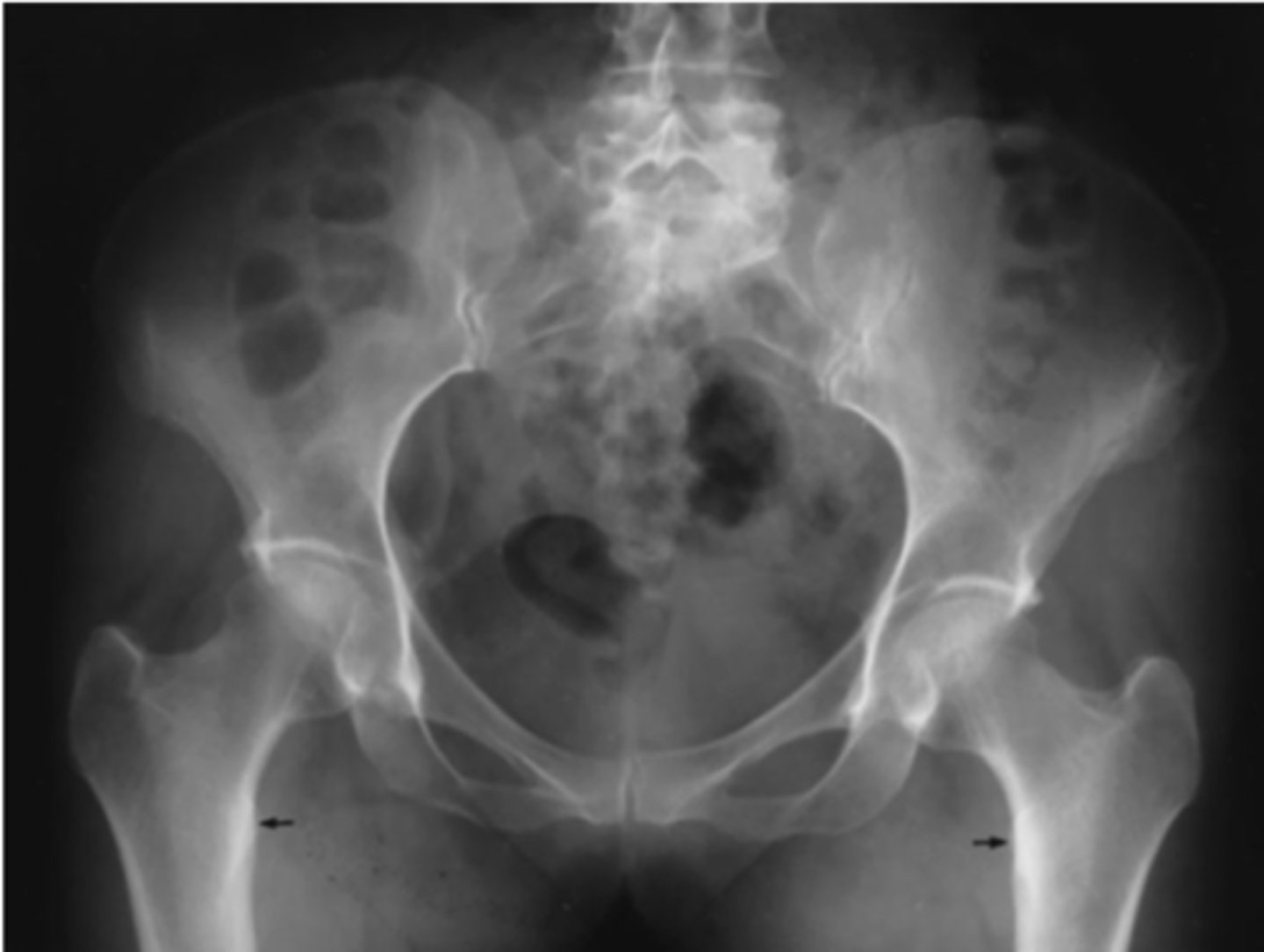 <p>Which femur rotation was present for this projection</p>