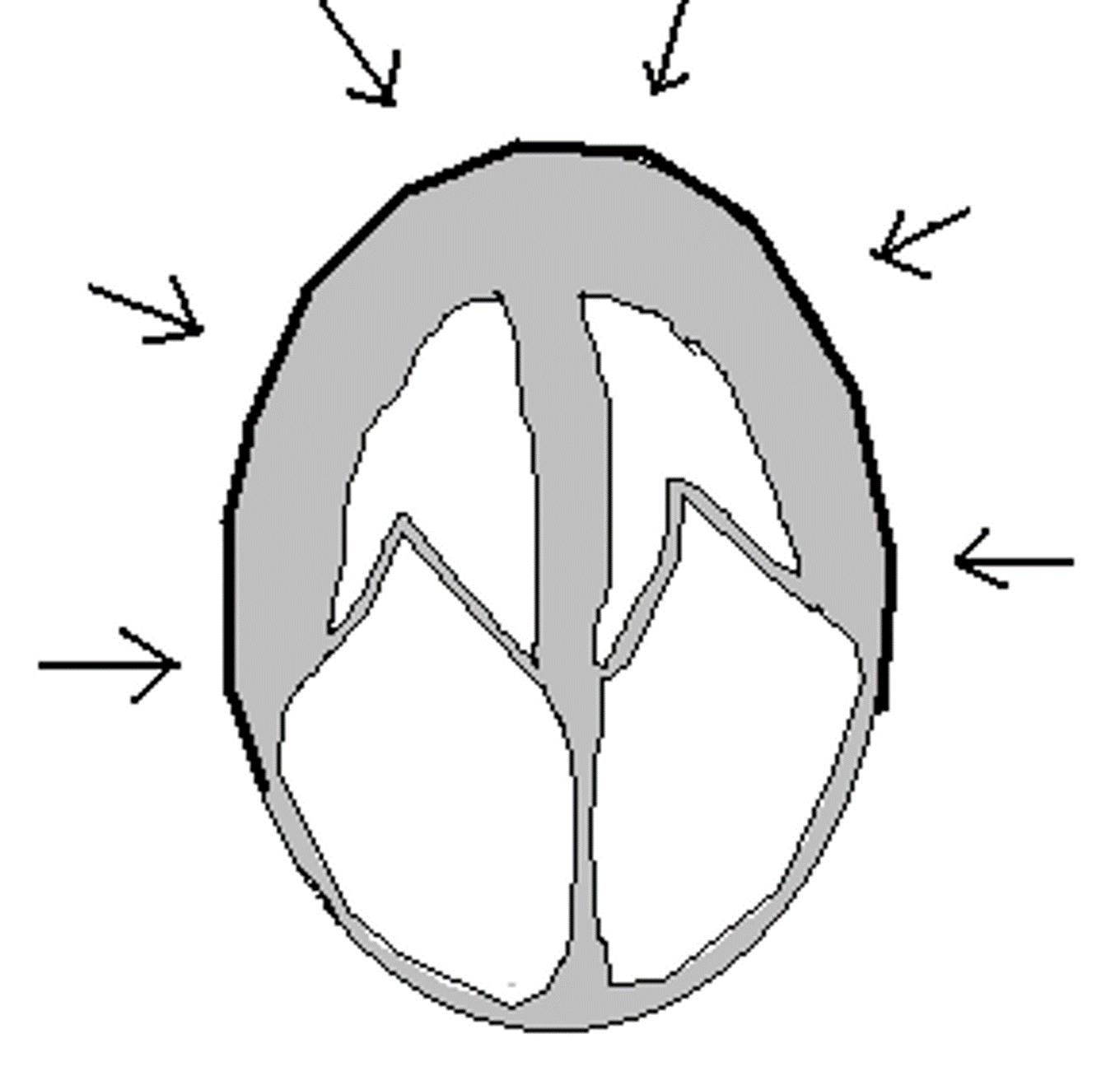 <p><strong>Pericarditis versus Restrictive Cardiomyopathy</strong>: Select all the following answers (multiple answers) that apply to the image:</p><p>Surrounds entire heart, impedes diastolic filling</p><p>Restrictive/ Infiltrated Cardiomyopathy</p><p>Constrictive pericarditis</p><p>Large MV E, small A, with respiratory changes</p><p>Involves infiltrated myocardium, stiff ventricular walls, impedes diastolic filling</p><p>Large MV E, small A, without respiratory changes</p>