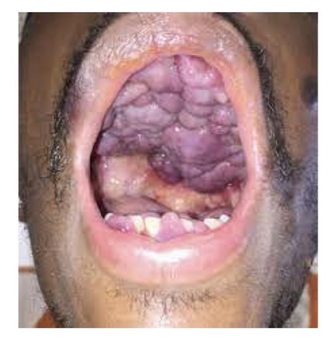 <p>These may arise in multiple sites including the skin and oral mucosa. Historically, seen in older men, more aggressive form has arisen with HIV. Lesions are often seen in the oral cavity as purple macules, plaques, or exophytic tumours. Most commonly on the hard palate and gingiva. May also occur in pts with immunodeficiency.</p>