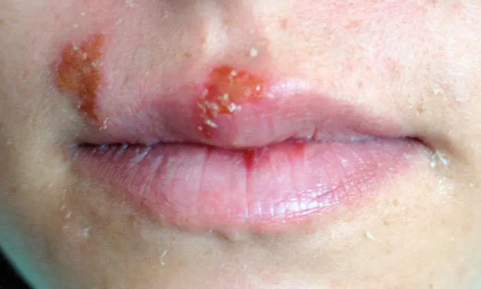 <p>Herpes Simplex</p>