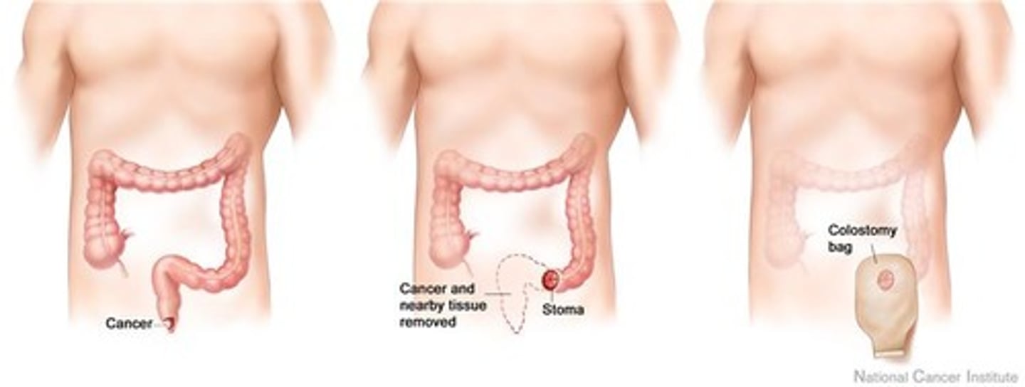 <p>Anterior incision is made in abdominal wall to make a colostomy, and a perineal incision is made to resect rectum, anus, and lymphatics. The pelvic floor is reconstructed with a mesh, peritoneum or omentum.</p>