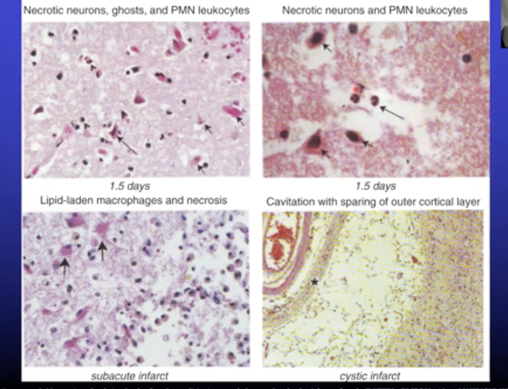 <ul><li><p>Neuronal damage and death → neurons becomes red</p></li><li><p>Loss of myelin (oligodendrocyte loss of function)</p></li><li><p>Death of glia cells</p></li><li><p>Loss of tissue with clearing reaction via influx of granulocytes and macrophages (colliquation, when the damaged tissue becomes liquid)</p><ul><li><p>Cavitation (a hole)</p></li></ul></li></ul>