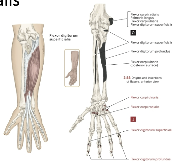 <p>Nerve that the Flexor Digitorum Superficialis innervates</p>